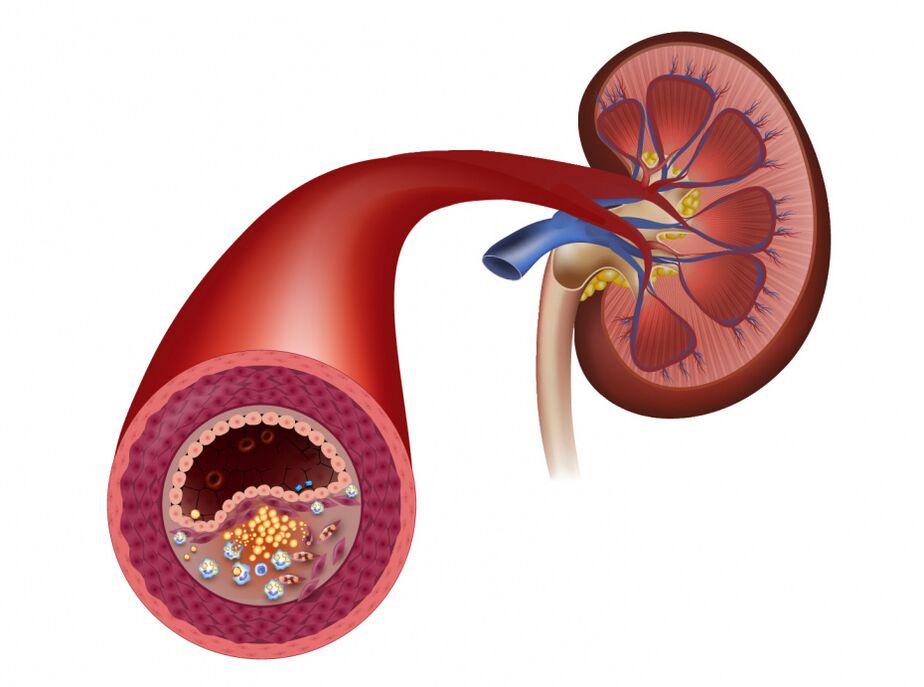 Reducing blood flow due to atherosclerosis